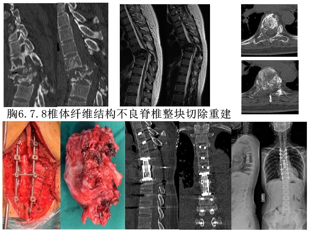 胸椎6.7.8椎体肿瘤3节段脊椎整块切除,人工椎体重建