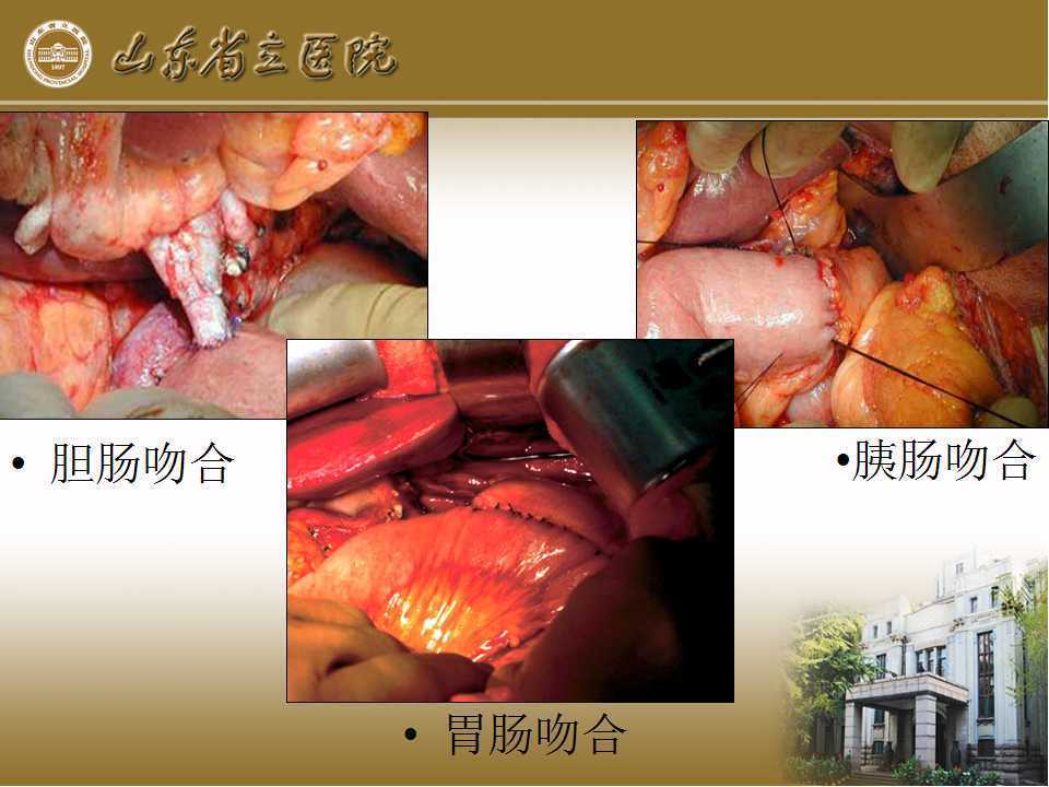 胰十二指肠切除术手术须知