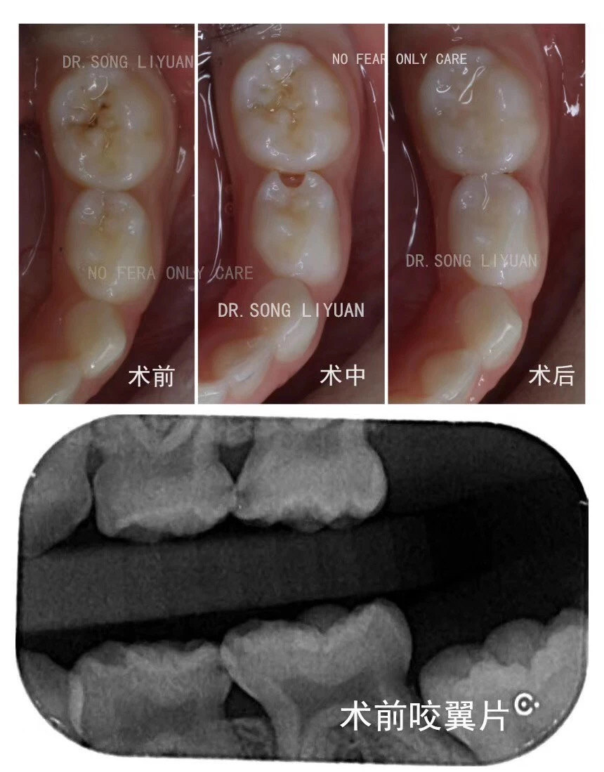 最易被忽视的邻面龋