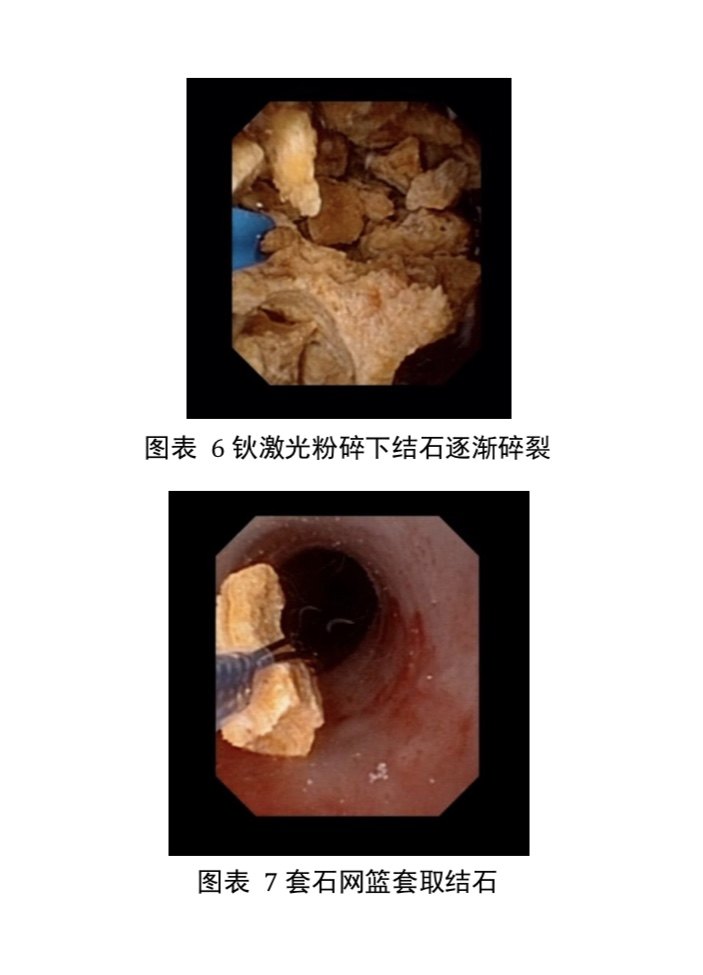 输尿管软镜手术——一种"无创"肾结石手术方式