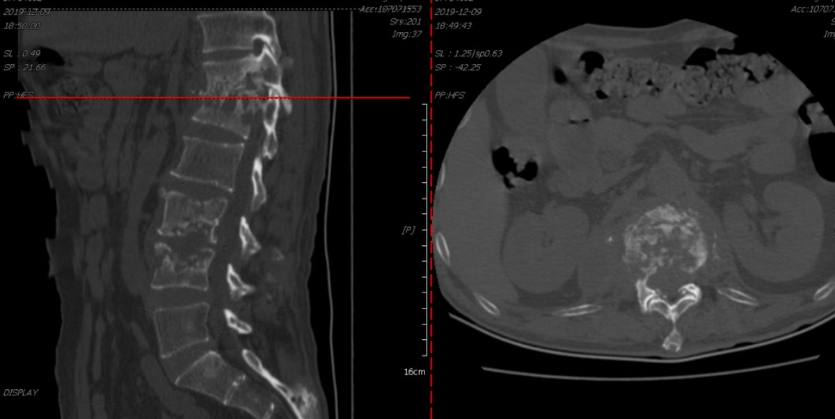 ct:胸12-腰1虫噬样骨质破坏,伴有死骨