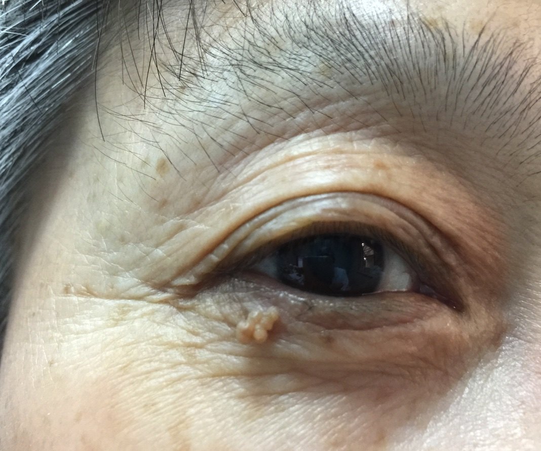 眼皮上长颗痣,最好的治疗方法是什么?