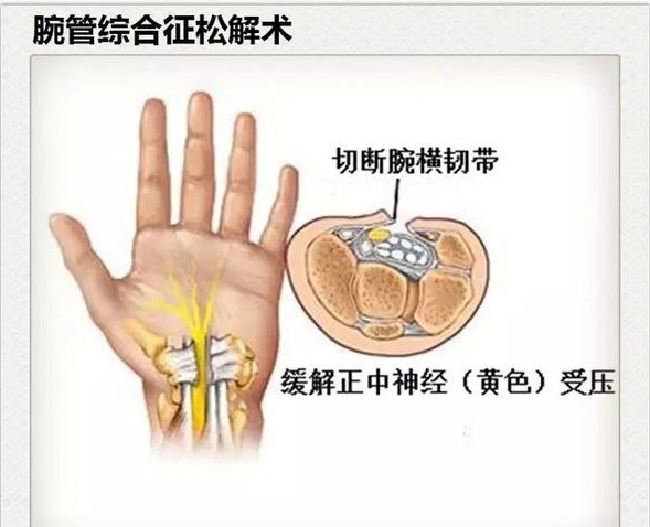 腱鞘炎在早期可先行保守治疗,首先使患手休息,局部夹板或石膏托固定3