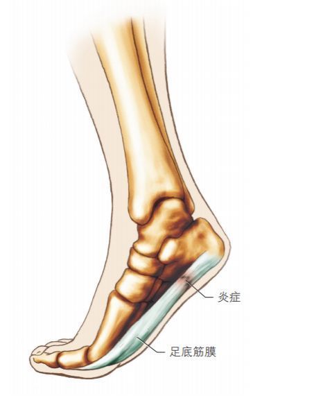 足底筋膜炎足跟痛常见的一种原因如何诊治可以手术吗