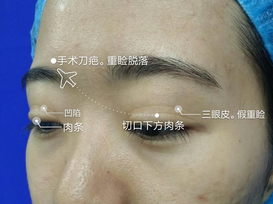 同时切口上方由于去除过量组织造成凹陷,继发形成高位的假性双眼皮.