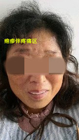 头上长了带状疱疹怎么办