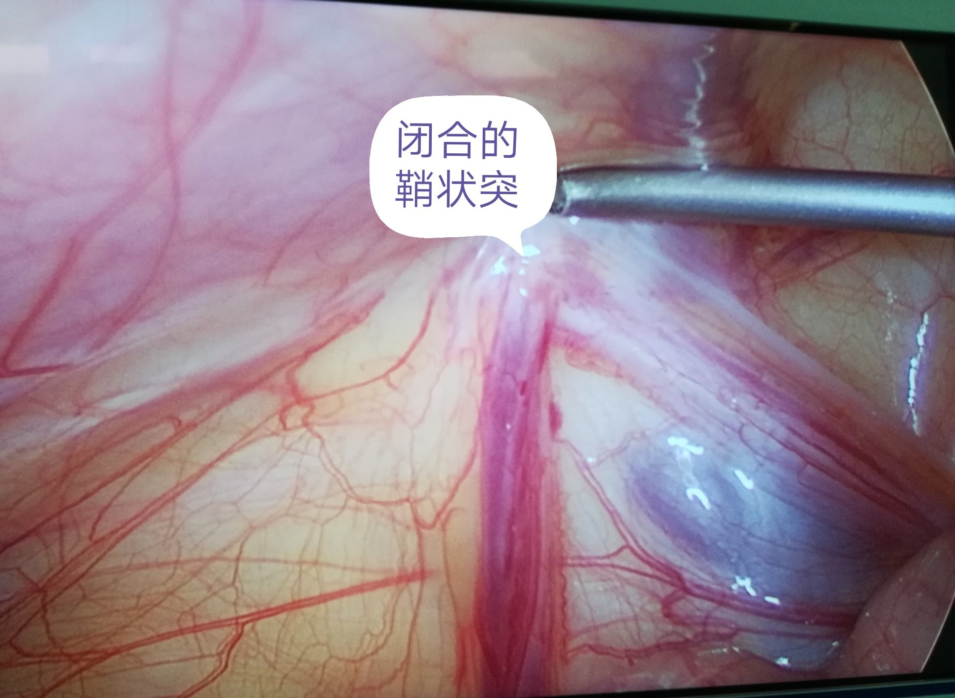 小儿鞘膜积液的治疗