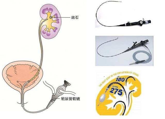 而且末端可上下弯曲180°至270,通过人体自然腔道进入膀胱,输尿管
