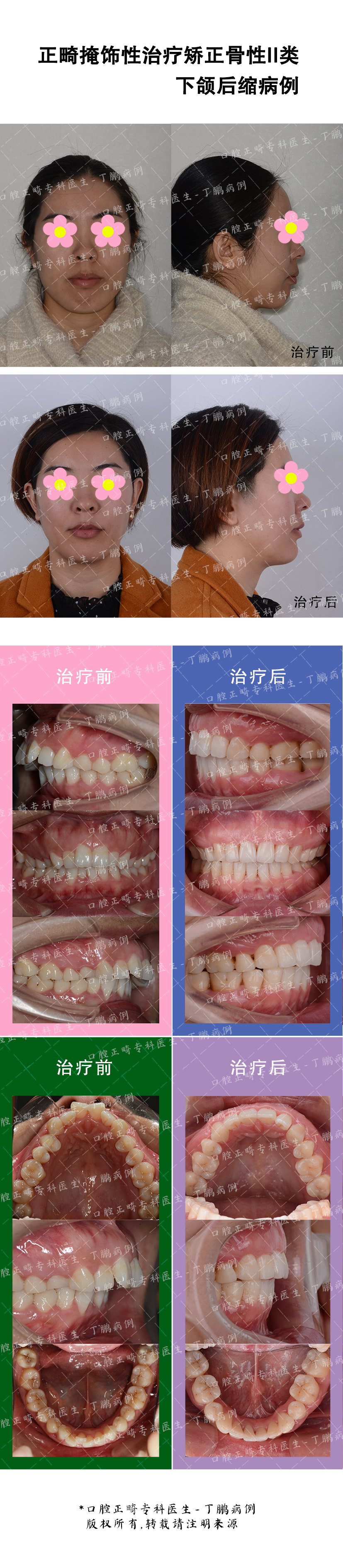 正畸掩饰性治疗骨性il类下颌后缩一例