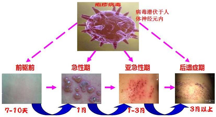 这种神经痛很顽固为啥带状疱疹好了却还是痛