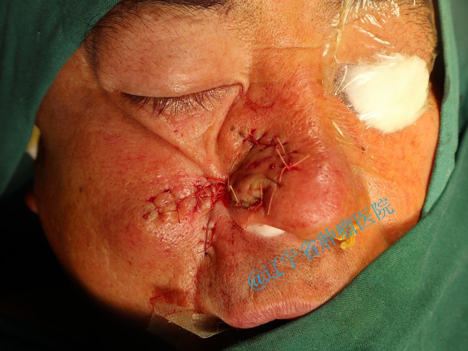 面部皮肤恶性肿瘤手术病例