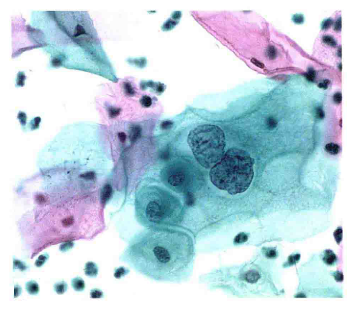 从细胞,组织的角度认识低度鳞状上皮内病变_宫颈癌前