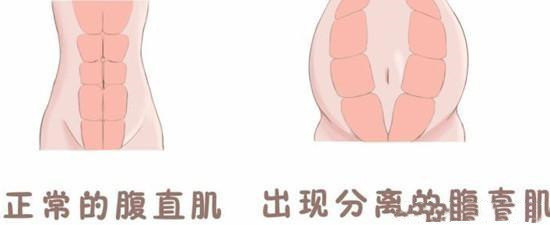 产后腹部松弛难以改善您可以试试这样做