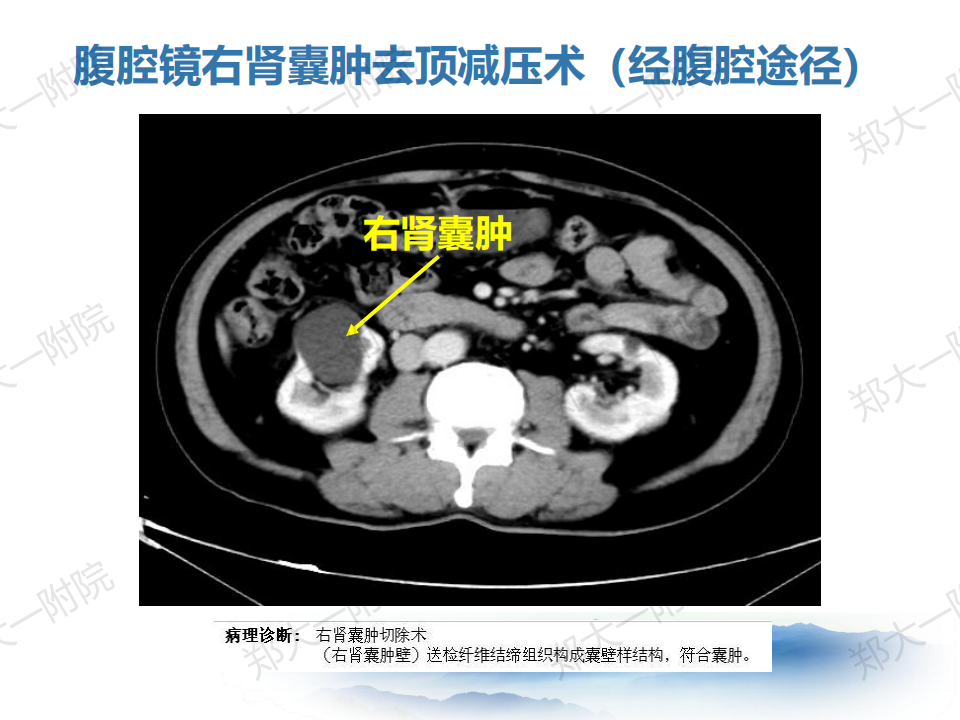 肾囊肿的诊断和治疗经验