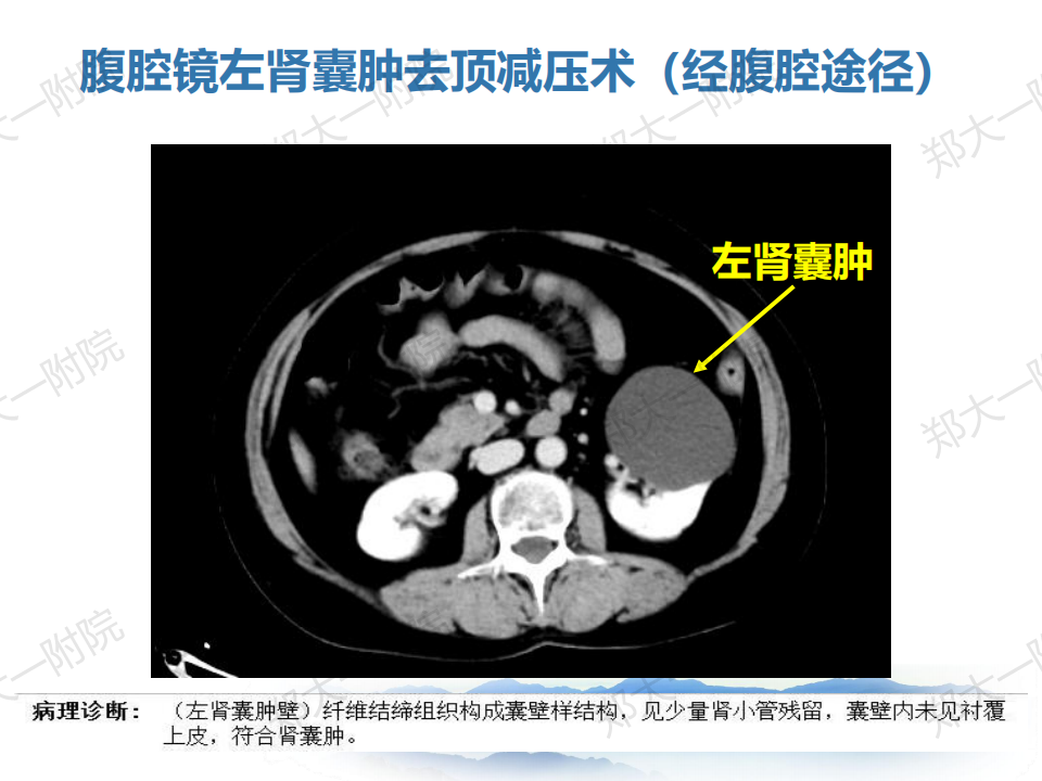 肾囊肿的诊断和治疗经验