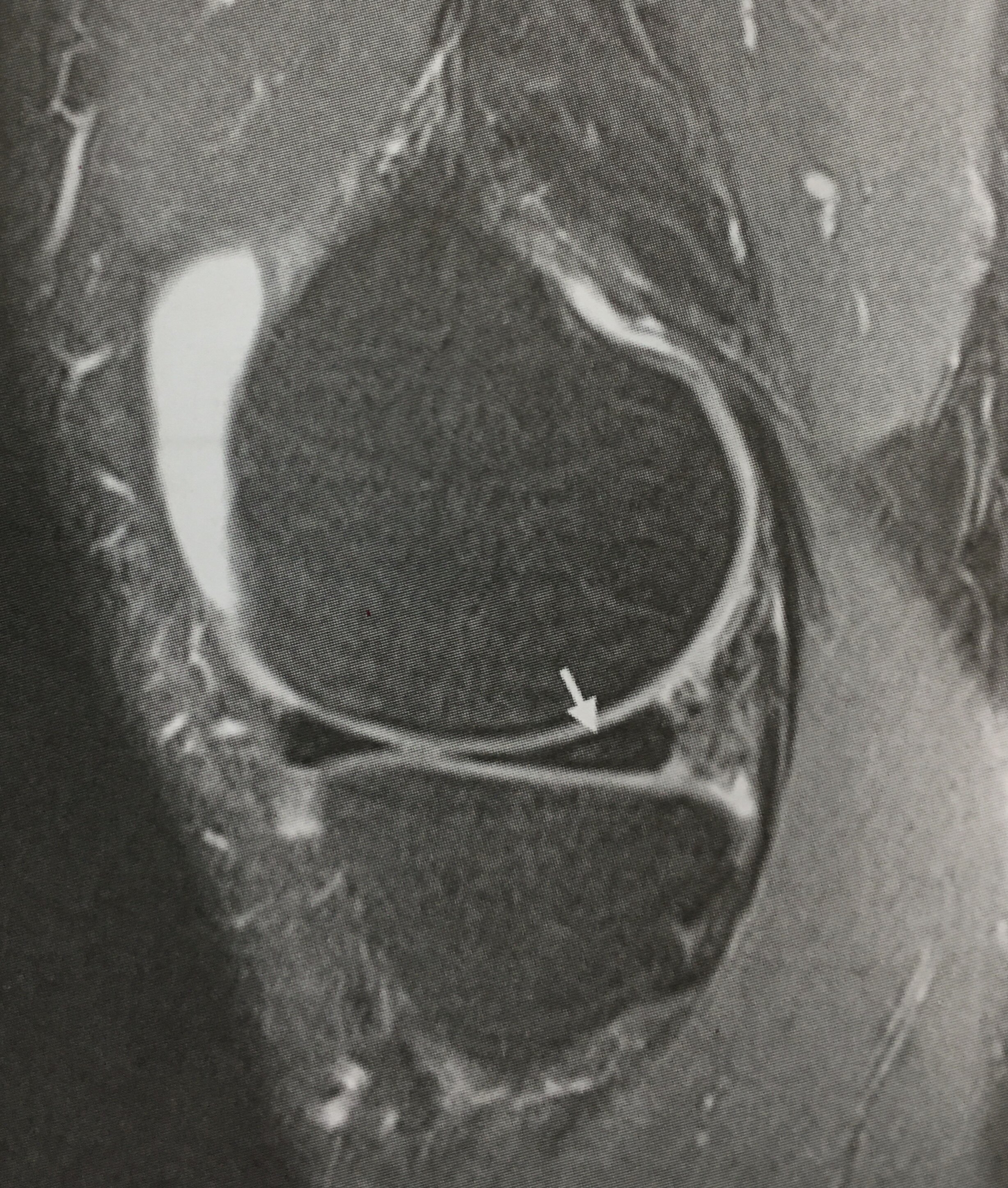 浅谈半月板损伤2