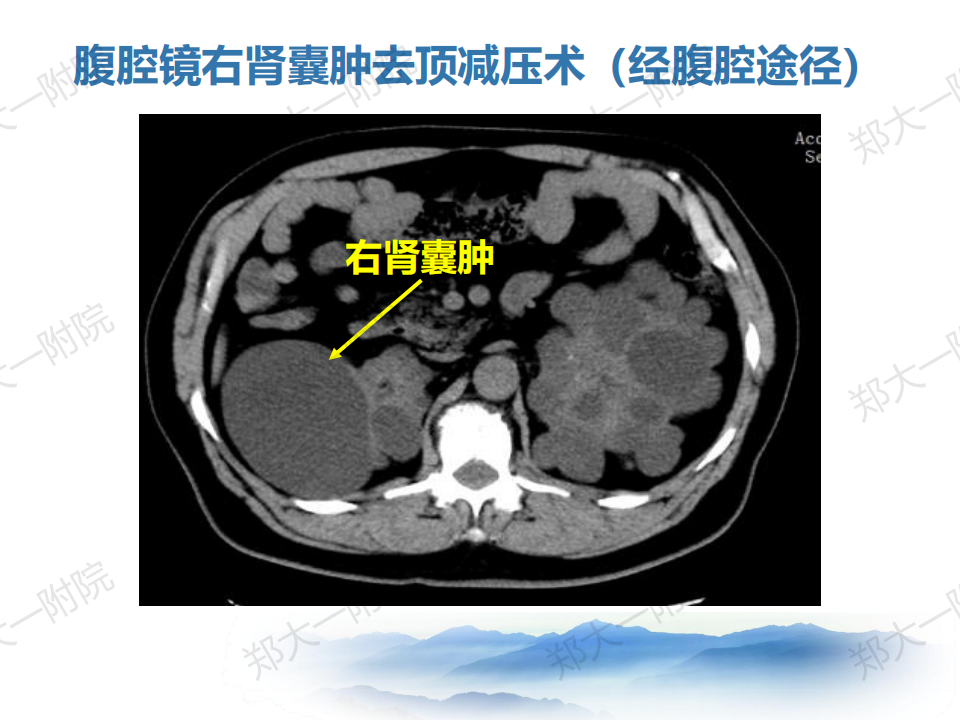 肾囊肿的诊断和治疗经验