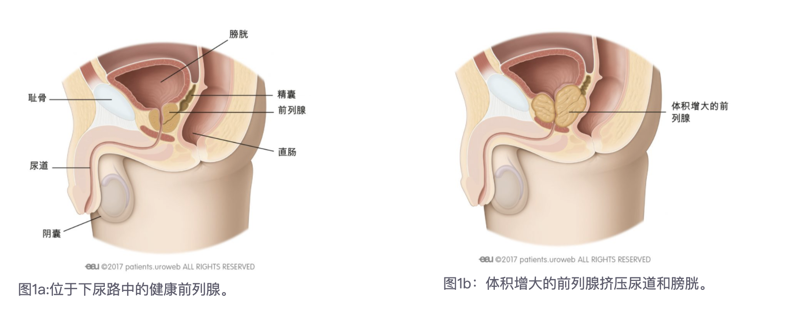 前列腺增生到底是怎么回事?您知道么?(一)