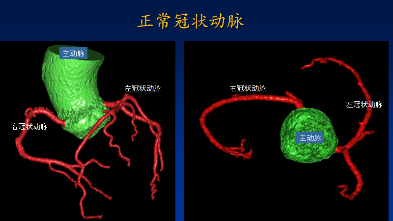 先天性冠状动脉起源异常与心源性猝死