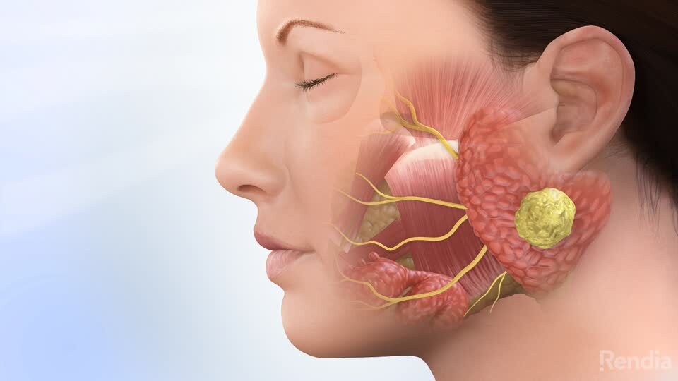 腮腺肿瘤术前术后常见问题解惑