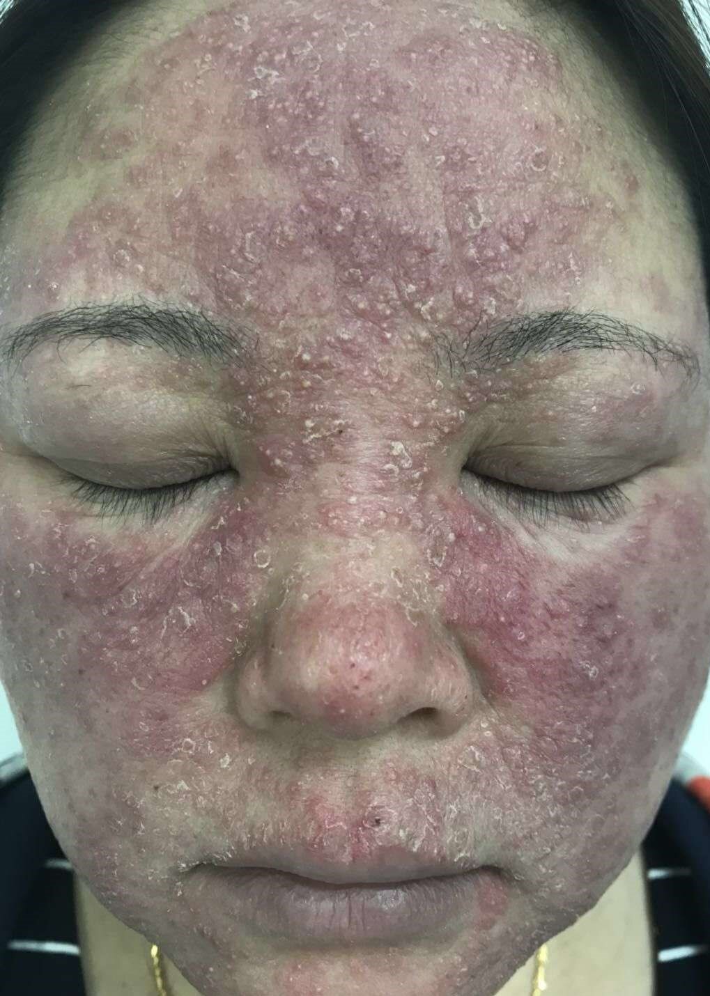在2018年7月,患者面部开始出现红斑,并伴有灼痛和瘙痒,寻求治疗后