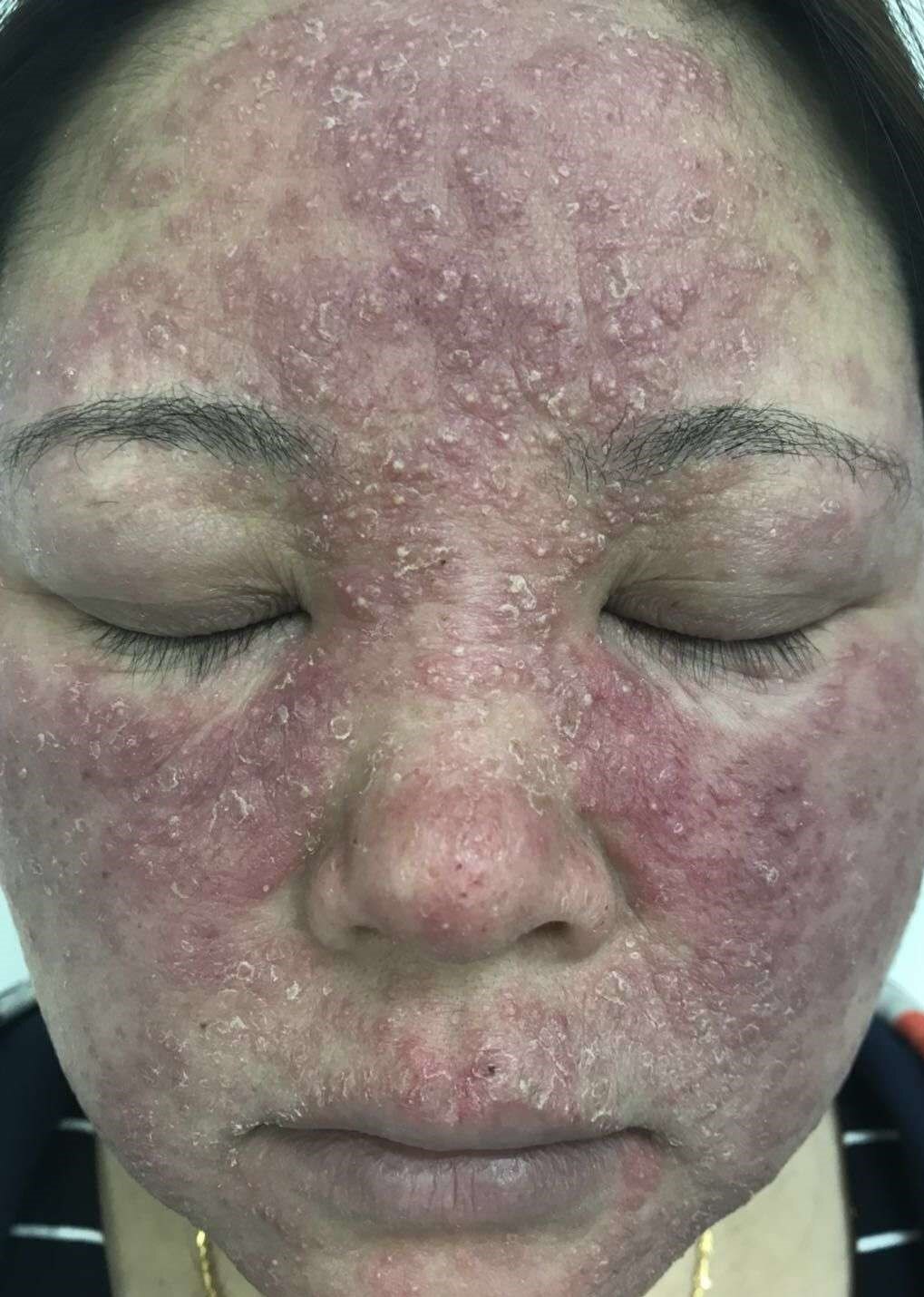 新的一面锦旗,谈谈玫瑰痤疮患者的综合治疗