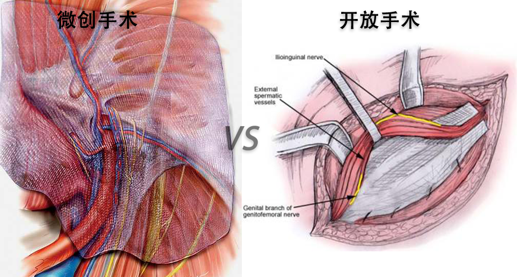 成人腹股沟疝微创手术与开放手术的感性比较