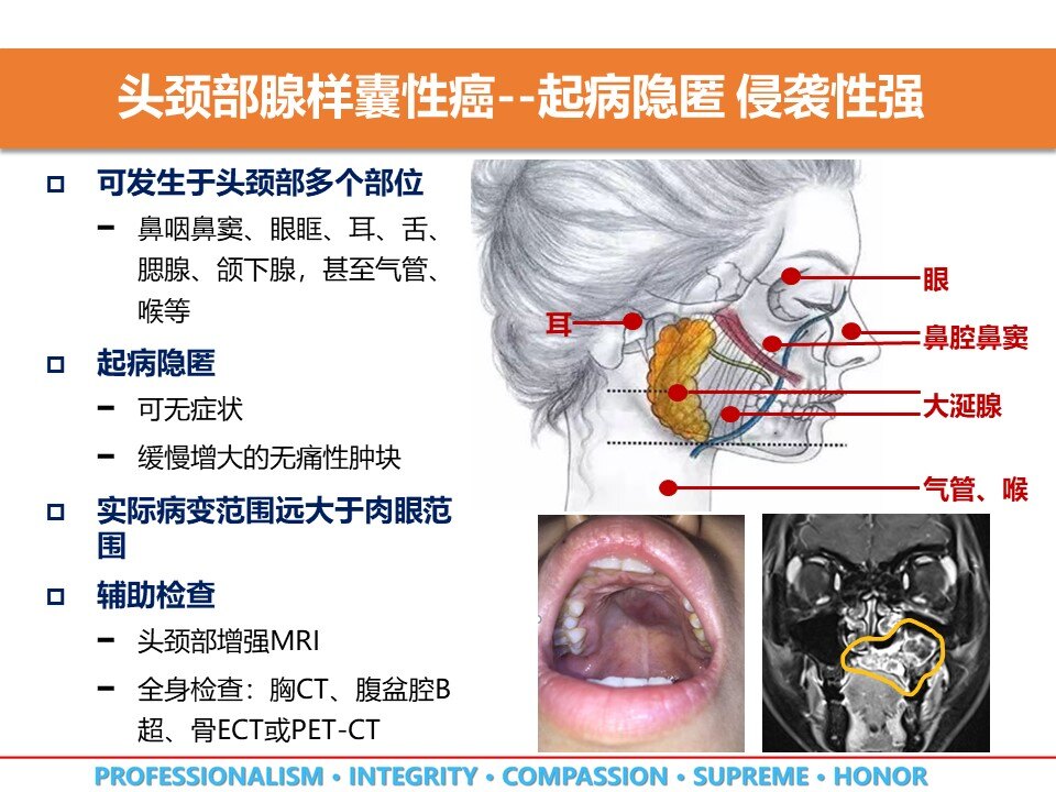 该疾病可发生于头颈部多个部位,如眼眶,鼻腔鼻窦,鼻咽,腮腺,颌下腺