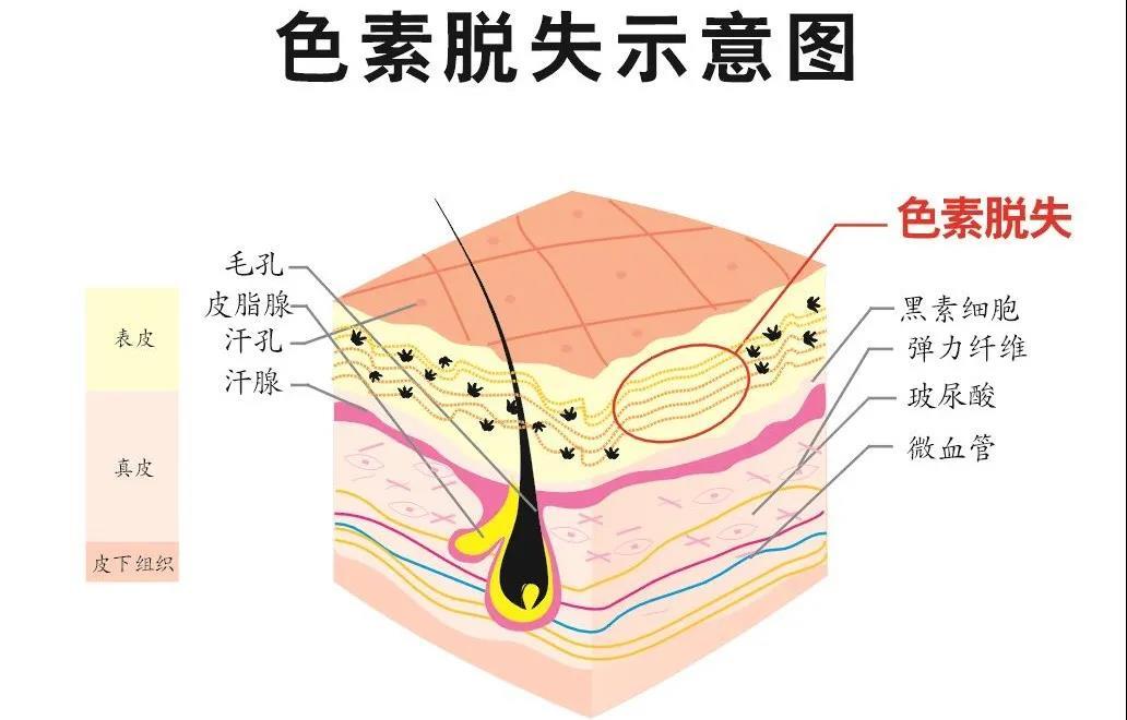 主要是由于皮肤伤及真皮层下后,真皮层中存在的大量黑色素细胞异常