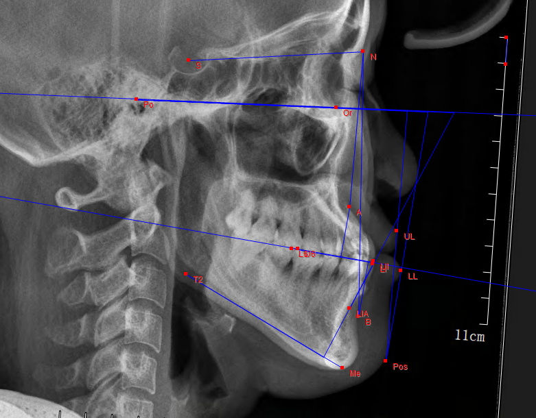 x线头颅侧位片了解过或经历过的患者都知道,牙齿矫正前一定要做的四件
