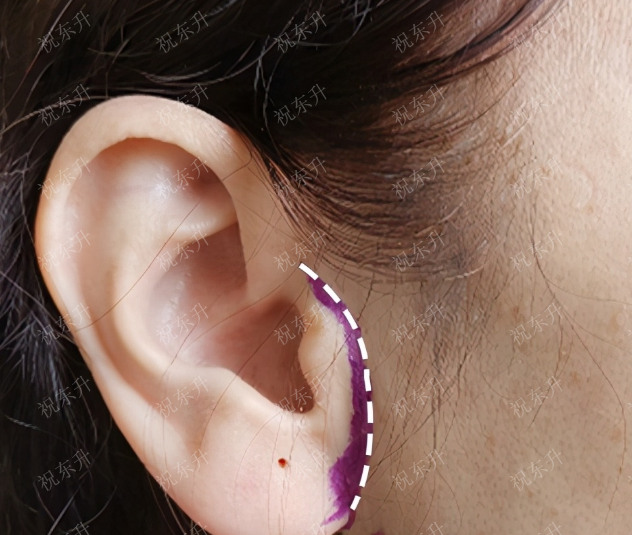 拉皮手术即便在耳前做切口,会紧贴耳轮前缘,皮肤自然褶皱纹理处,加上