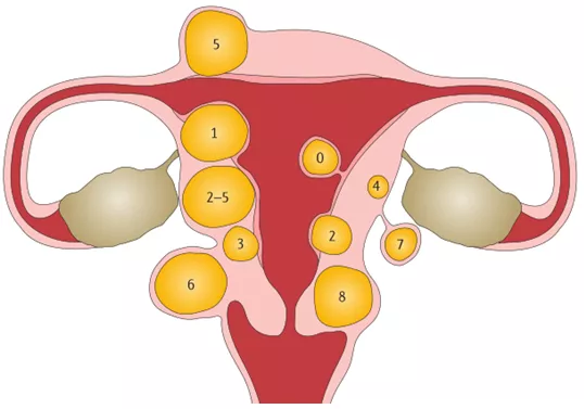 (figo)依据肌瘤相对于粘膜和浆膜表面的位置将子宫肌瘤分为八类(图2)