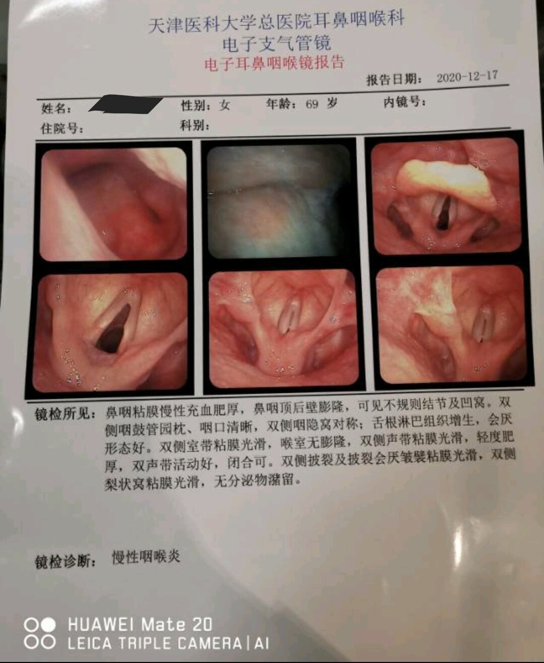 刘懿博士说肺癌(一六六九)肺癌术后两个月血痰和气管插管有关吗?