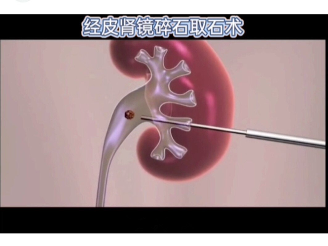 泌尿系结石的常见外科治疗方法(附本医疗组治疗病例中