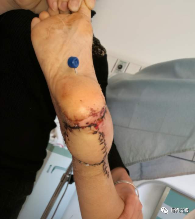 9岁孩童右脚皮肤挫伤感染坏死,上海六院文根显微皮瓣成功保肢手术团队