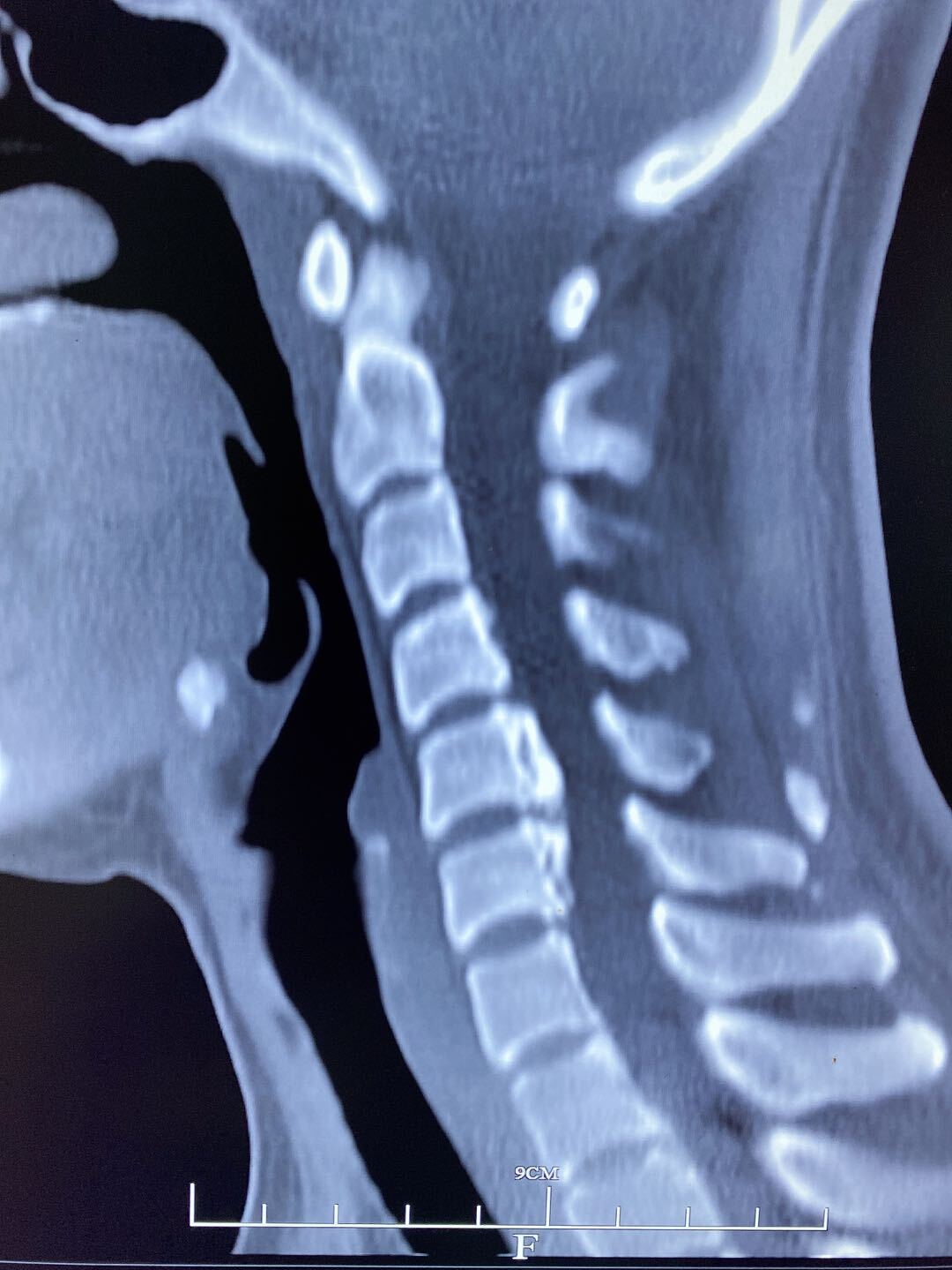 经过颈椎ct及磁共振检查后,诊断出两节段颈椎间盘巨大突出合并有严重