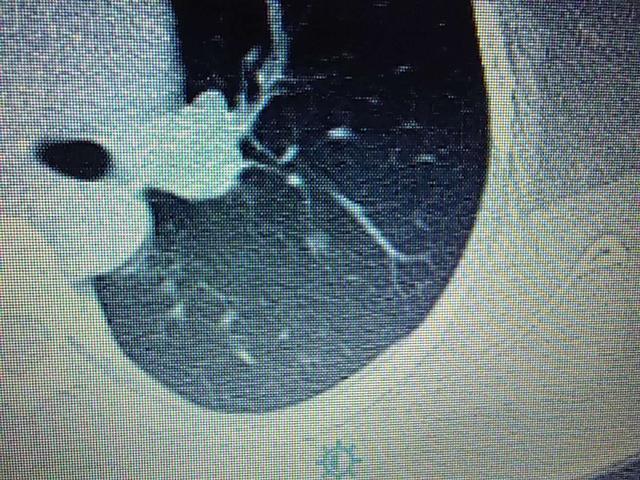 发现了肺上5 mm的磨玻璃影样结节需要立即手术吗?