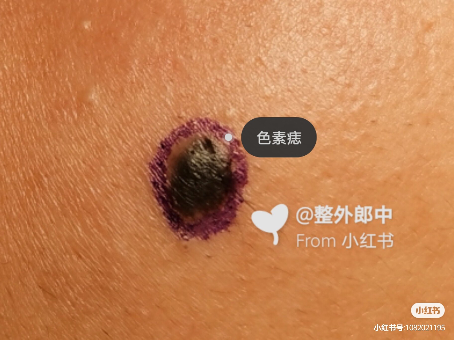 郎中亮 患者教育:黑色素瘤(基础篇) 黑色素瘤是一种严重的皮肤癌