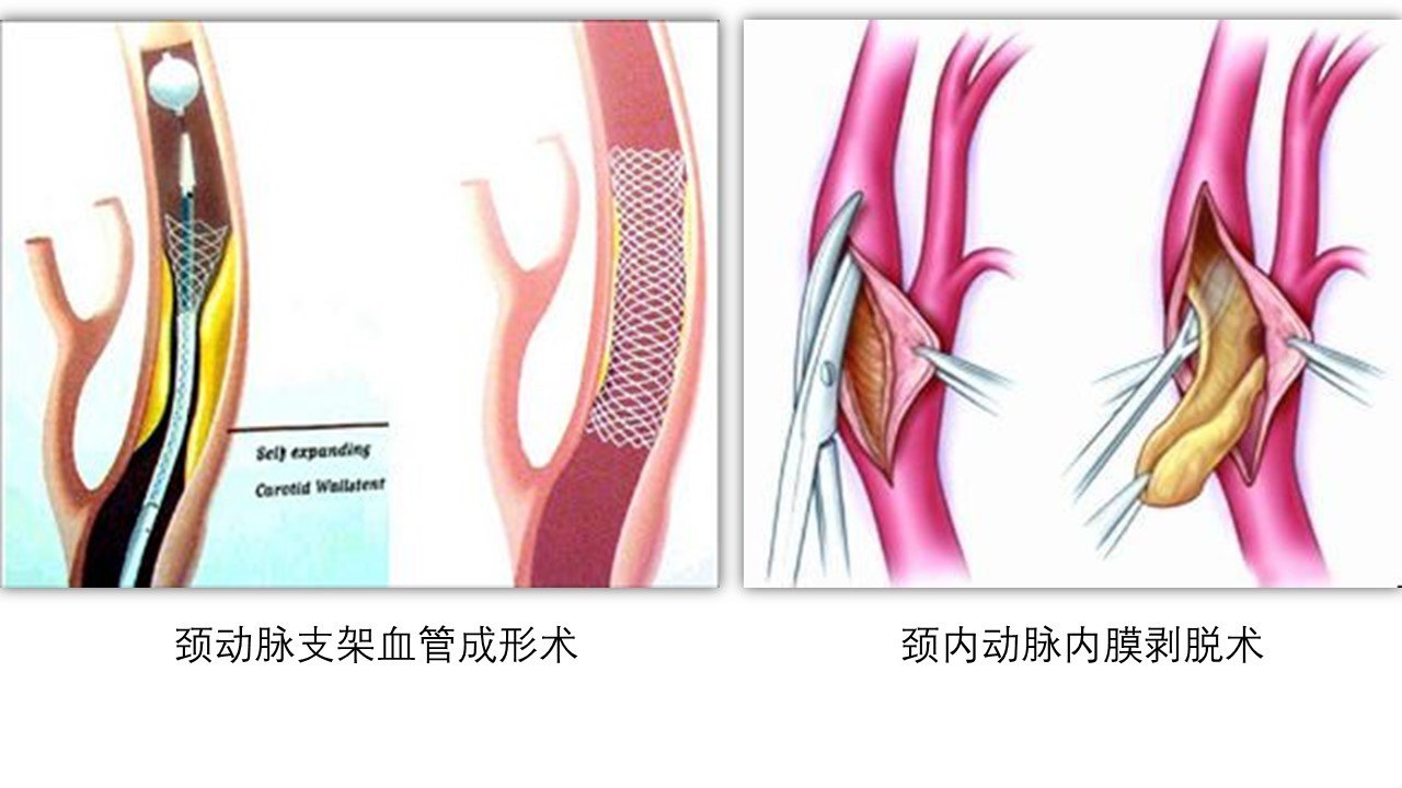 颈动脉狭窄应该怎样治疗