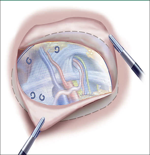 成人腹腔镜腹股沟疝修补术问与答_腹股沟疝_