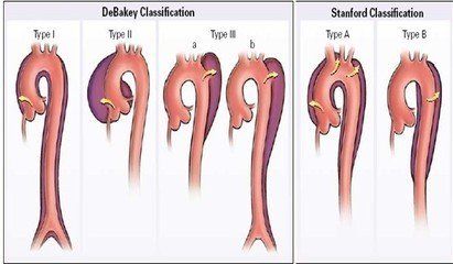主动脉疾病科普系列之主动脉夹层