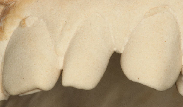 前牙过小牙齿小牙齿畸形患者瓷贴面美学仿真修复