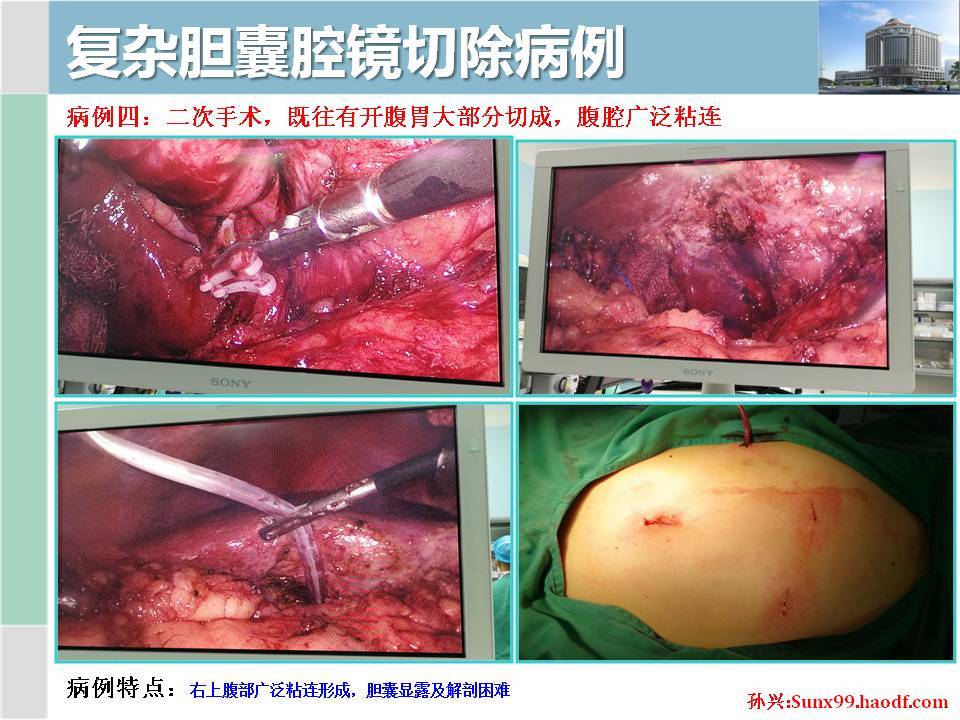 腹腔镜胆囊切除术lc术者孙兴