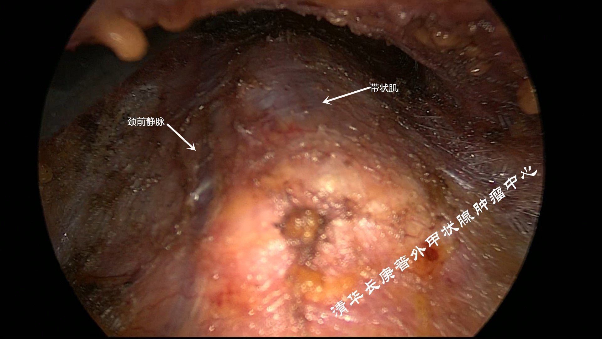 经口腔镜甲状腺癌手术有什么优势?适用于哪些病人?