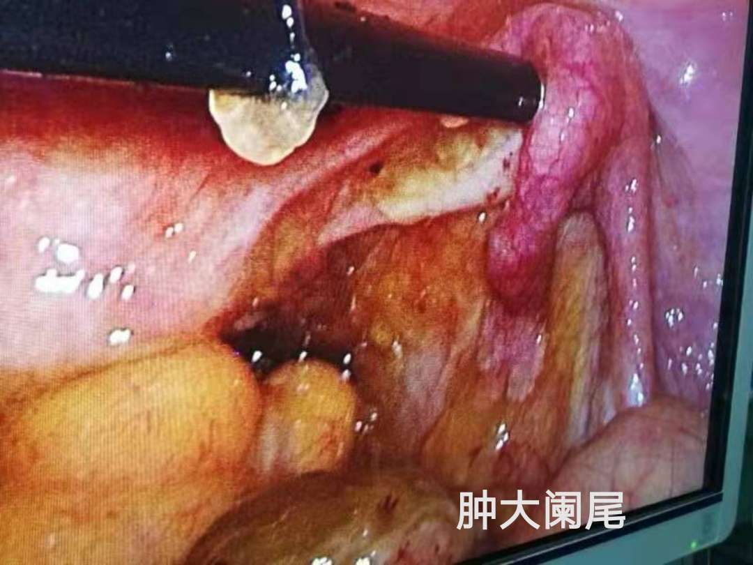 1 2019.6以腹痛就诊ct提示阑尾增粗腹膜转移血肿瘤标志物正常,于2019.