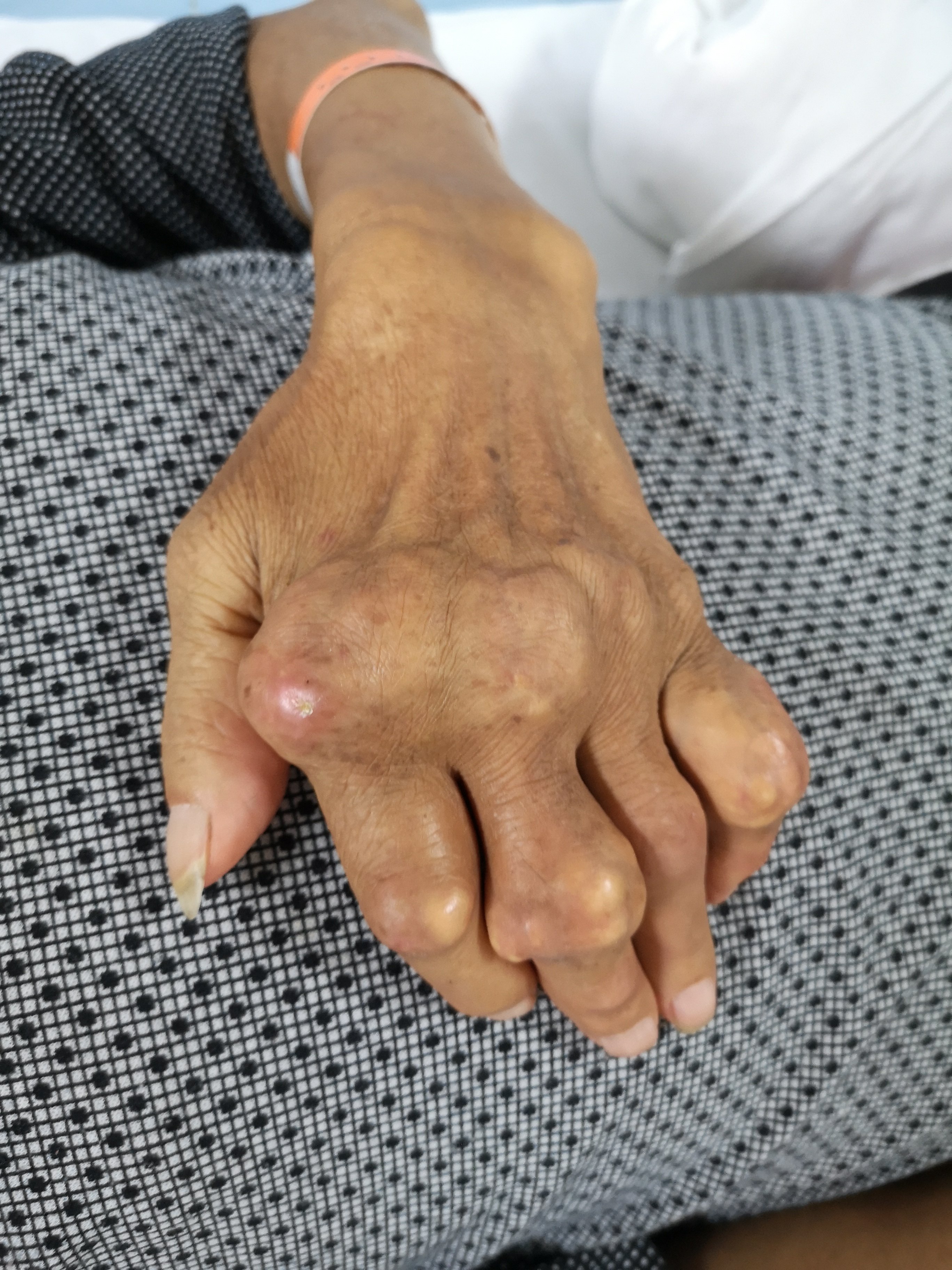 手指关节痛风结石