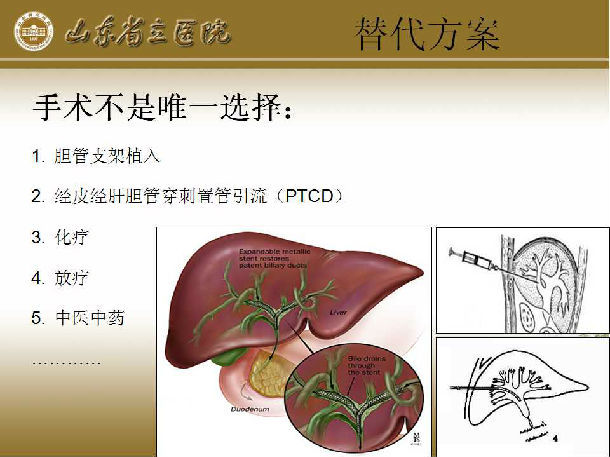 好大夫在线 朱化强 肝门部胆管癌手术须知(附多