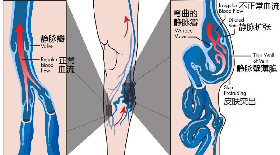 钱塘血管外科论坛下肢静脉曲张大型义诊暨中国微循环学会静脉曲张专家