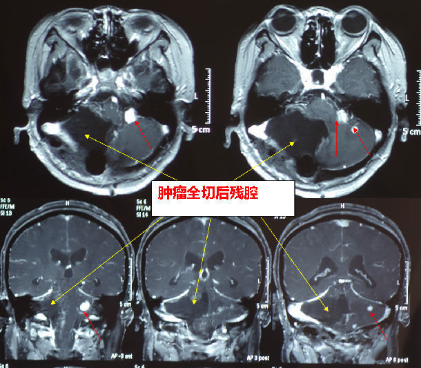 小脑血管母细胞瘤的手术体位配合