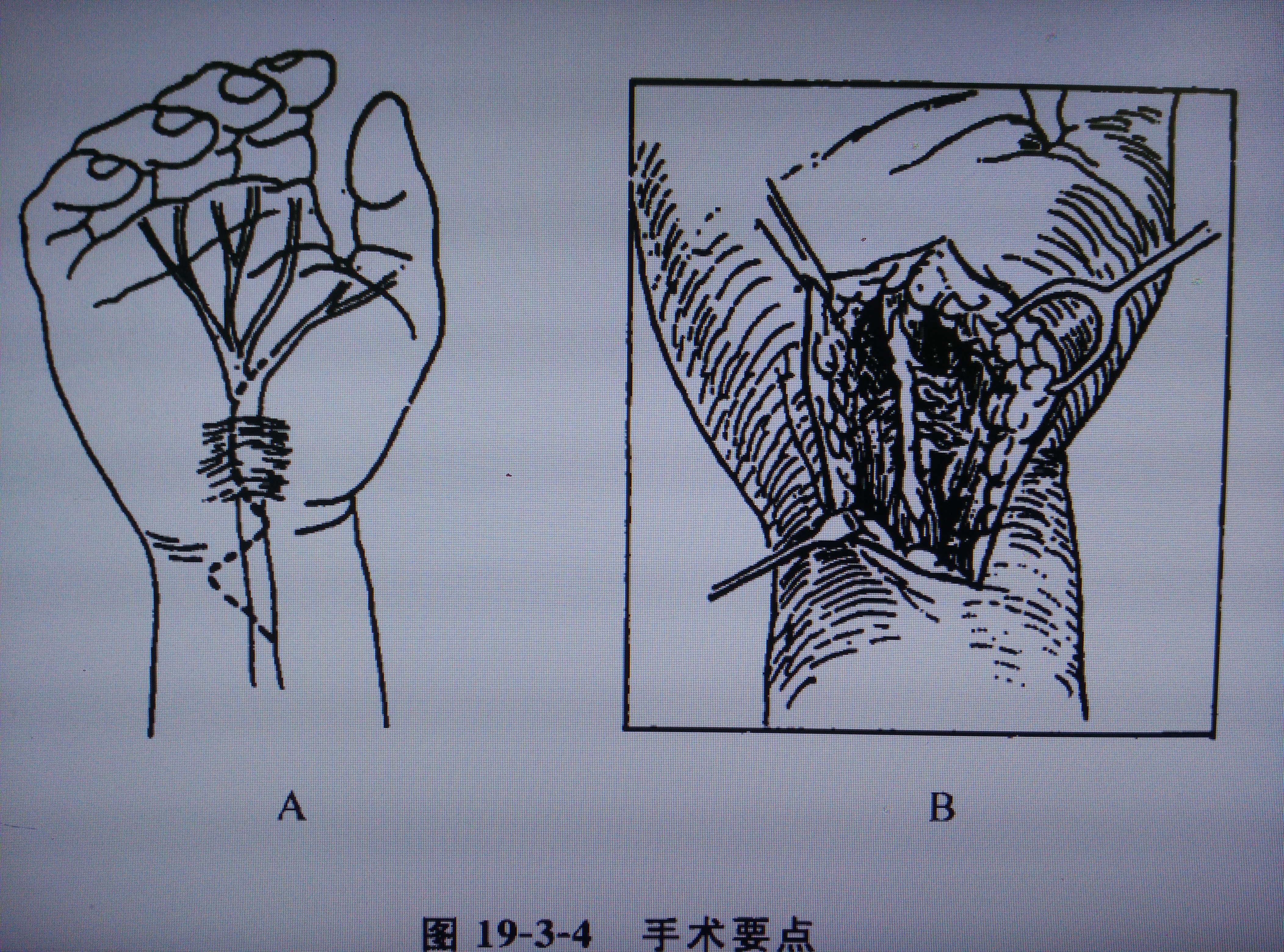 开放式手术切口